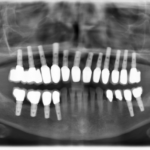 zahnmedizin, patient, implantat, kosten